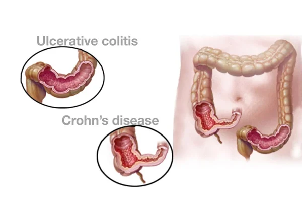 Crohns Disease