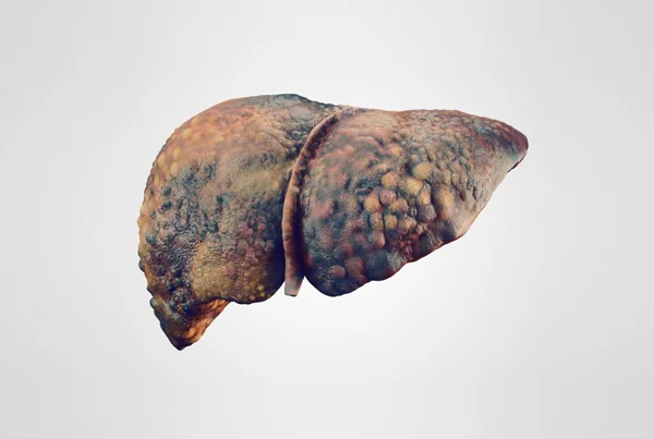 Alcoholic Liver Disease