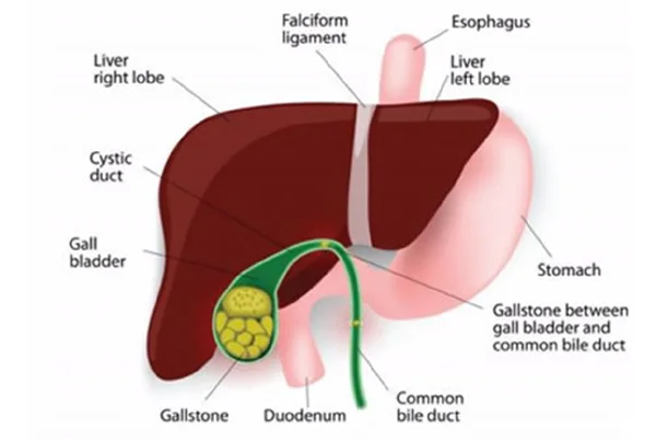 Gallbladder Stone Surgery