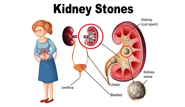 Kidney Stone Surgery