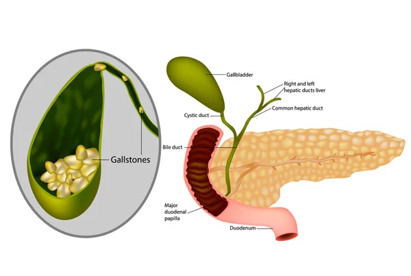 Cholelithiasis