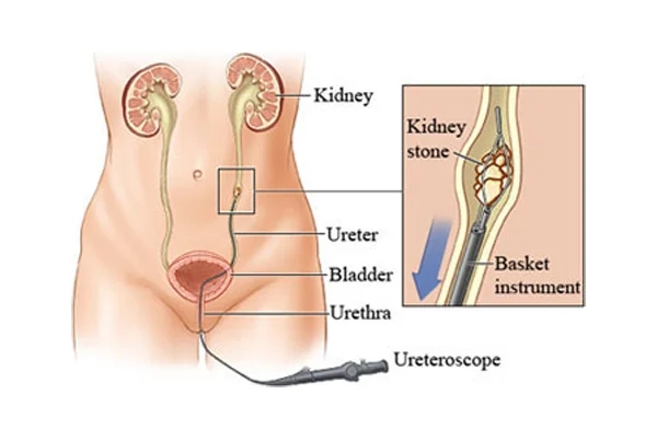 Ureteric Stone