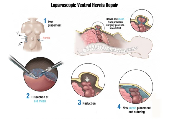 Ventral Hernia