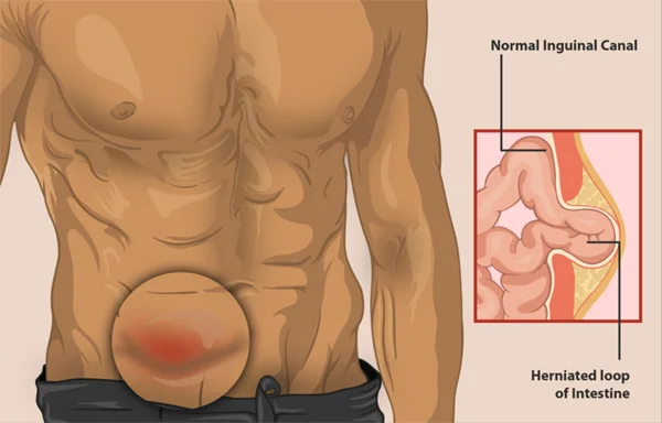 Femoral Hernia
