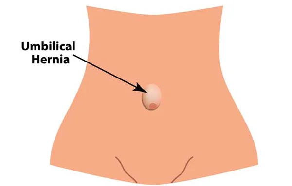 Umblical Hernia