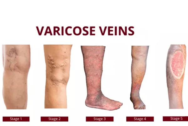 Varicose Veins
