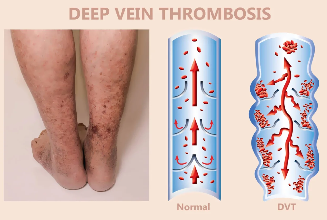 Deep Vein Thrombosis