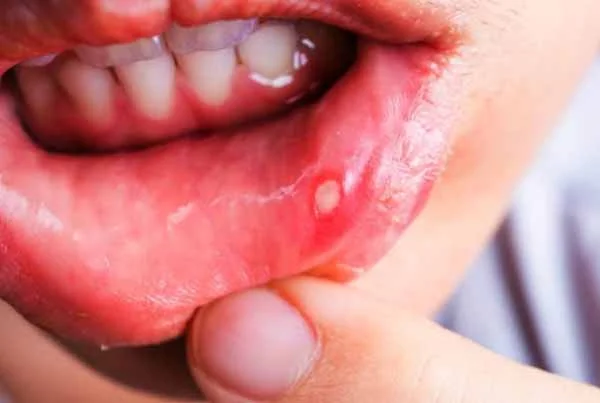 Ulcer