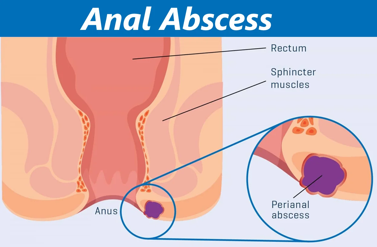 Abscess Surgery