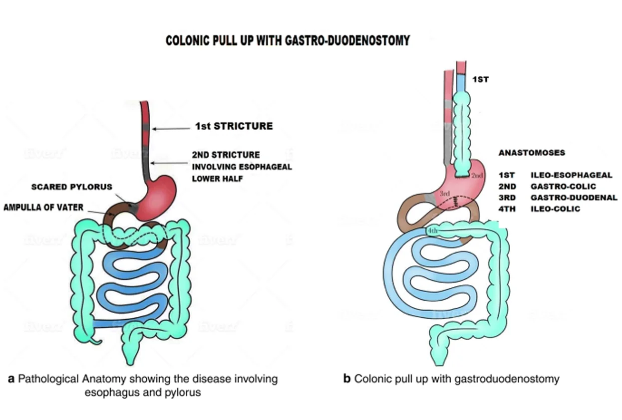 Stricture