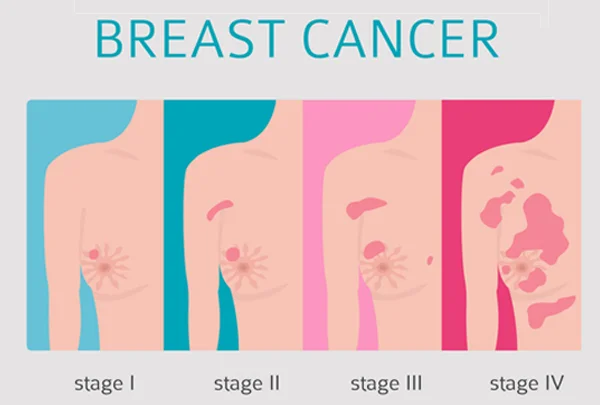 Breast Cancer