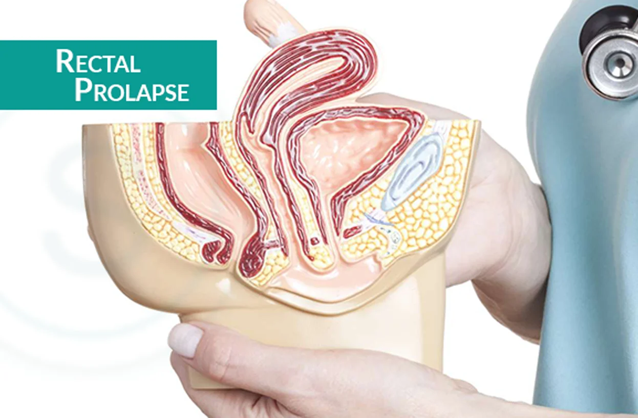 Rectal Prolapse